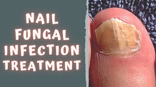 HOW TO TREAT FUNGAL NAIL INFECTION  TINEA UNGUIUM  ONYCHOMYCOSIS [upl. by Idnerb]