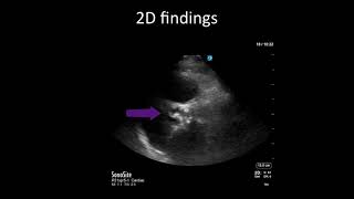 PointofCare Echo Aortic Stenosis vs Sclerosis [upl. by Leugimesoj]