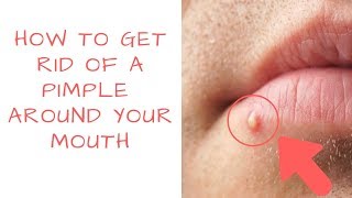 How to get rid of PIMPLES Around your mouth  PrettyBoyFloyd 🌹 [upl. by Soulier]