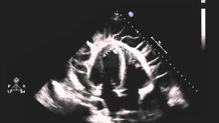 Echocardiogram of a Patient with Uremic Pericarditis [upl. by Yennep]