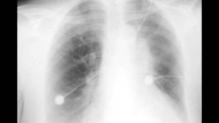 Left Upper Lobe Atelectasis on Chest X ray [upl. by Alaric]