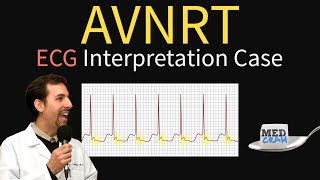 WolffParkinsonWhite WPW and Associated Arrhythmias [upl. by Atikal]