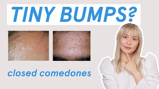 Why those tiny bumps AREN’T fungal acne [upl. by Digdirb]