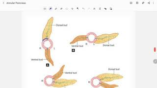 Annular Pancreas [upl. by Supple]