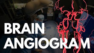 What is a coronary angiogram [upl. by Htehpaj]