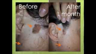 Natural treatment for seborrheic keratosis before and after photos [upl. by Emyam]