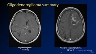 Introduction to MRI of the brain [upl. by Ewer]