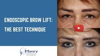 Endoscopic Brow Lift Video  Before amp After Brow Lift [upl. by Portingale]