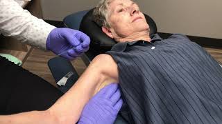 Treating Frozen Shoulder With Dry Needling [upl. by Fairman9]