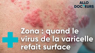 Toutes vos questions sur le zona  Allo Docteurs [upl. by Aleron]