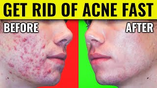 Say Goodbye to Acne Dr Bergs Proven Methods for Clearing Your Skin [upl. by Eilah]