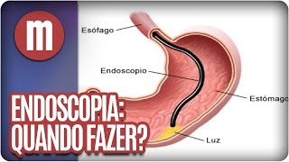 Endoscopia Quando fazer  Mulheres 120916 [upl. by Jaret]