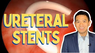 Ureteral Stent Insertion and Removal  Procedure in Detail [upl. by Norreht]