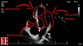 Heart Failure Treatment of HF with Reduced Ejection Fraction HFrEF [upl. by Dnalyram]