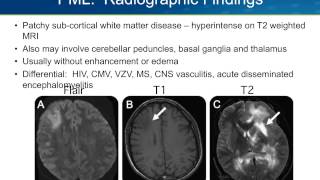 Progressive Multifocal Leukoencephalopathy PML [upl. by Llennhoj370]