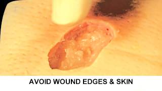 Enzymatic Debridement Demonstration Understand Wound Care [upl. by Nwavahs]