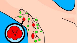 How to Ease Swollen Lymph Nodes in the Armpit [upl. by Rhoades811]