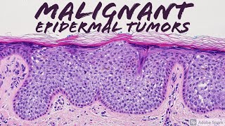 Malignant Epidermal Lesions amp Mimics 101 Carcinoma Basics  Dermatopathology Dermatology Pathology [upl. by Parthen]