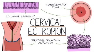 Understanding Cervical Ectropion  Cervical Erosion [upl. by Enimisaj]