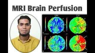 MRI Brain perfusion [upl. by Eiramnna]