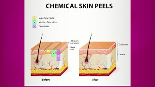 Chemical Peel Purpose amp Types [upl. by Lander446]