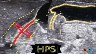 Hypertrophic pyloric stenosis [upl. by Odella]