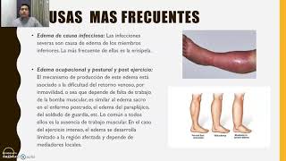 edema miembros inferiores [upl. by Alleacim]