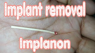 Implant birth control removal  Implanon [upl. by Valerio]