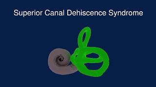 Superior Canal Dehiscence Syndrome SCDS [upl. by Nnyleimaj]