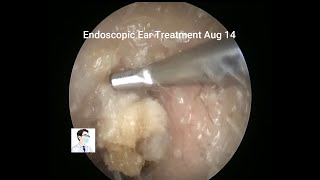 Left lateral auditory canal cholesteatoma clearance process clip 18 minutes [upl. by Paulita]