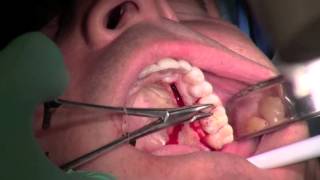 Palatal Gum Grafting [upl. by Cita]