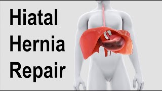 Hiatal Hernia Repair Animation [upl. by Ahseat]