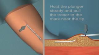 Jadelle insertion and removal Tutorial [upl. by Liberati]