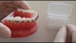 Comment mettre de la cire orthodontique [upl. by Ennirak]