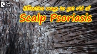 Scalp psoriasisSymptom Cause Treatment  Safe ways to Wash Hair Dr Rasya Dixit Doctors Circle [upl. by Lupita856]