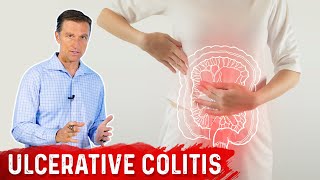 What is Ulcerative Colitis – Causes Symptoms amp Treatment by DrBerg [upl. by Bowra]