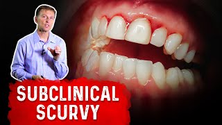 Vitamin C Deficiency Subclinical Scurvy – Causes Symptoms and Remedies – Dr Berg [upl. by Tierney]