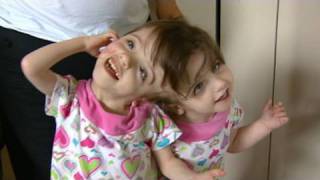 Conjoined Twins Twin Girls A Medical Wonder [upl. by Kcoj]