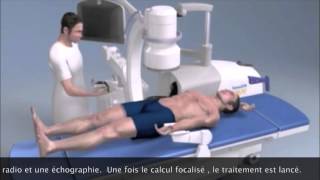 Lithotripsie extra corporelle  Extracorporeal Shock Wave Lithotripsy Montpellier [upl. by Erbes]