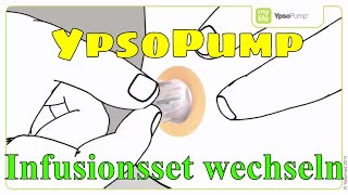 YpsoPump Infusionsset wechseln Insulinpumpe mylife Diabetescare 09 [upl. by Lehsreh561]