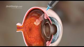 AntiVEGF Injections Richie Eye Clinic [upl. by Eninej184]