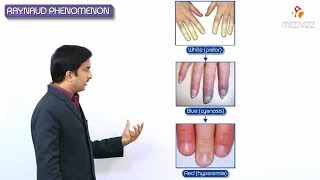 Raynauds phenomenon  Raynauds disease amp Raynauds syndrome [upl. by Rawde491]