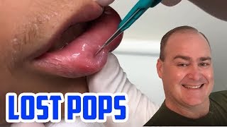 Dr Gilmores Lost Pops Cysts amp Pimples [upl. by Tommie]