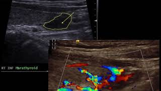 TMT Neck Ultrasound Parathyroid Nodule [upl. by Fredra]