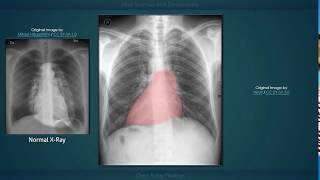 Situs Inversus with Dextrocardia Explanation of Chest Xray Findings [upl. by Enelehs959]