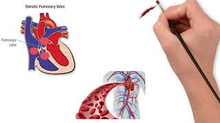 Pulmonary valve stenosis [upl. by Agnola]