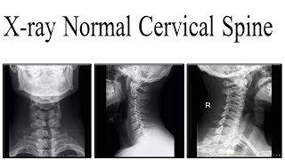 Xray Normal cervical spine anatomy [upl. by Koblas]