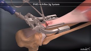 PARS Achilles Jig System [upl. by Shore433]