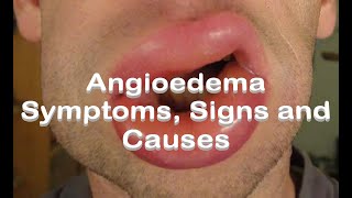 Hereditary Angioedema Described Concisely amp C1 Inhibitor Deficiency [upl. by Lustig]