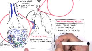 PART I  Pneumonia Overview Lobar and Bronchopneumonia [upl. by Laresa183]